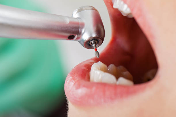 Best Dental Abscess Treatment in Fort Salonga, NY